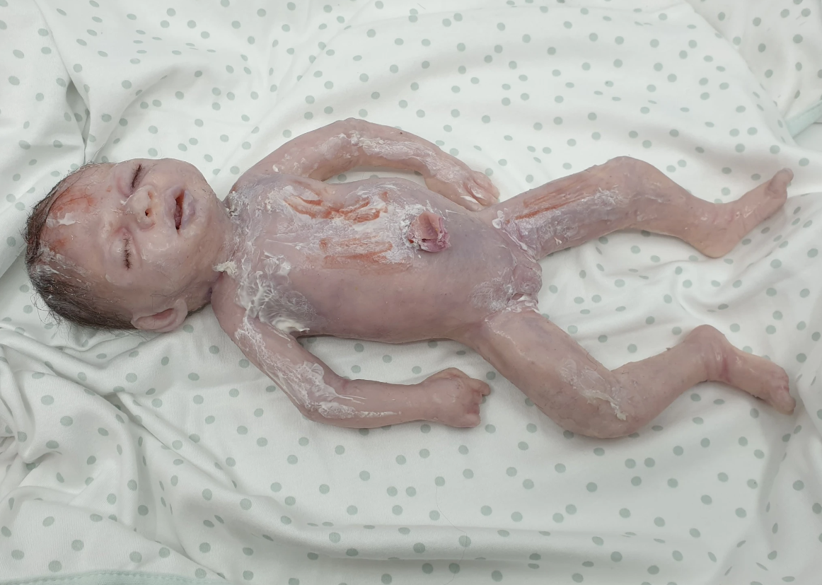 Фантом мертворожденного плода ANGEL LIBBY
