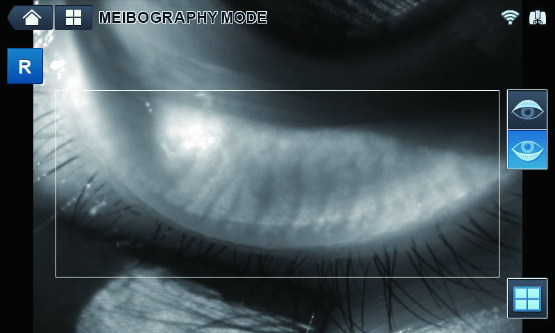 HRK Meibography.jpg